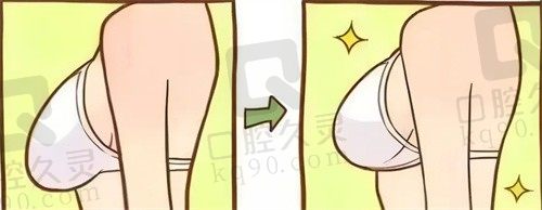北京王驰医生隆胸怎么样?奈菲尔傲秘隆胸5D可视化剥离损伤小技术好价格不贵