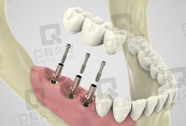 郑州植得口腔医院种植牙怎么样？医生技术+口碑+收费价格表综合评估很靠谱