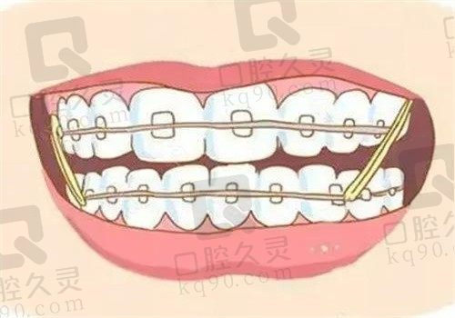 龅牙齿矫正方法有哪些？金属、隐形、舌侧以及正颌手术四种矫正方法