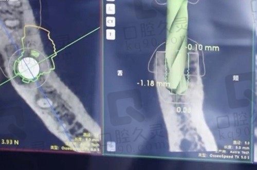 上海雅悦齿科种植牙口碑评价，就诊后给与雅悦齿科种植牙满分好评