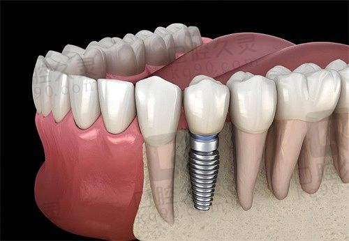 深圳诺德口腔医院韩国奥齿泰种植牙2580元，效果好，性价比高
