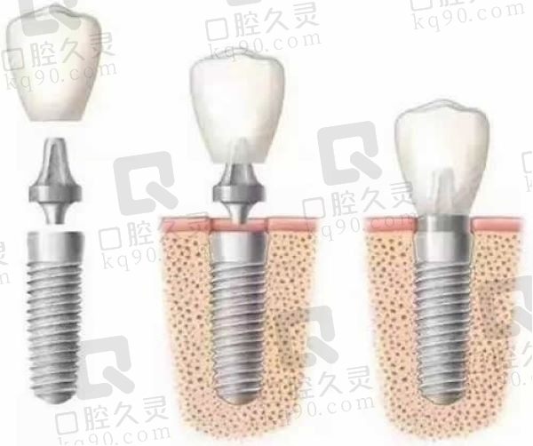 北京奥齿泰种植牙价格表查询:参考北京多家牙科医院知道最低1680元起一颗