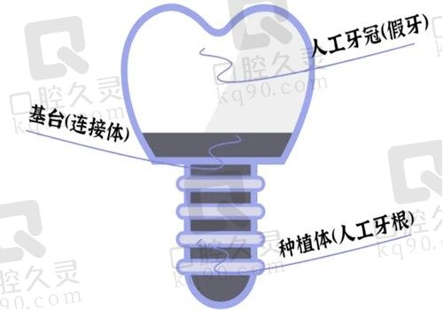 哈尔滨团圆口腔医院韩系种牙价格2000起，刘向医生种牙实力强