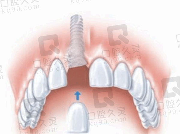 马龙桥种植牙多少钱？马龙桥种植牙与普通种植牙的区别