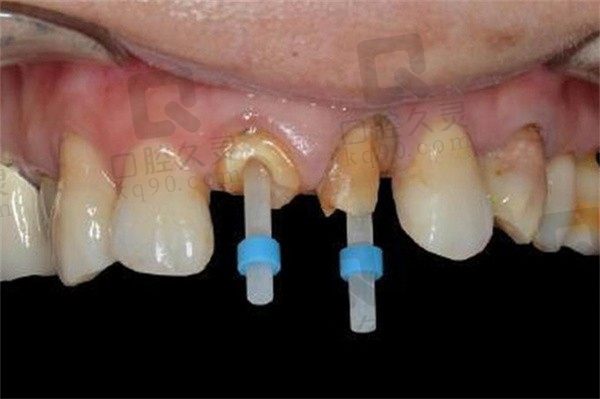 一般纤维桩加全瓷冠多少钱？1800元起一颗寿命可达十年以上