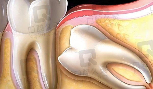 智齿非得拔掉吗？不拔会怎么样,长了智齿该怎么护理