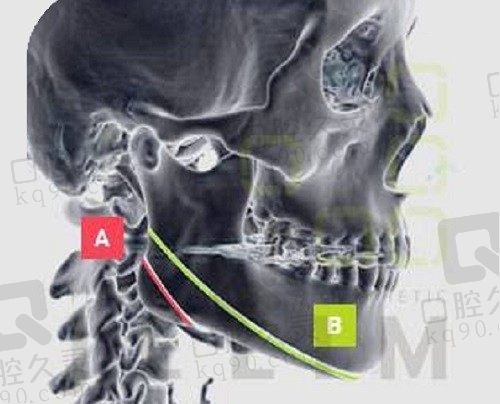 透漏北京圣嘉新磨骨价格，4w多就可找张笑天医生做下颌角磨骨术