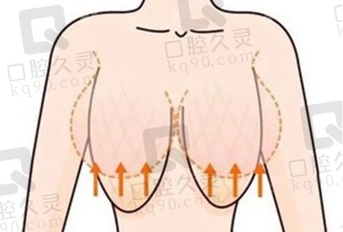 赵绛波医生缩胸手术3.8W起，乳房缩小手术实例多且至今无负面评价