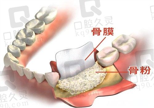 种植牙骨粉多少钱一克？国产均价在3000元，进口均价高达7000元一克