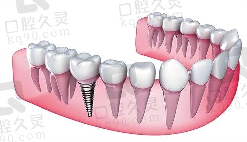 北京牙元素口腔德国威兰德全瓷牙2190元，做完后自然美观，舒适无异物感