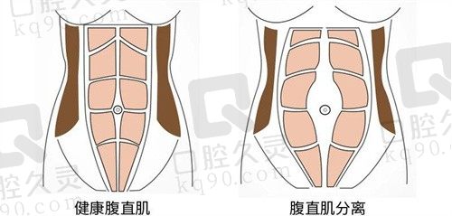 重庆当代医院腹壁成型术多少钱?安可忍医生腹壁成形1.88W起价格亲民技术超好！