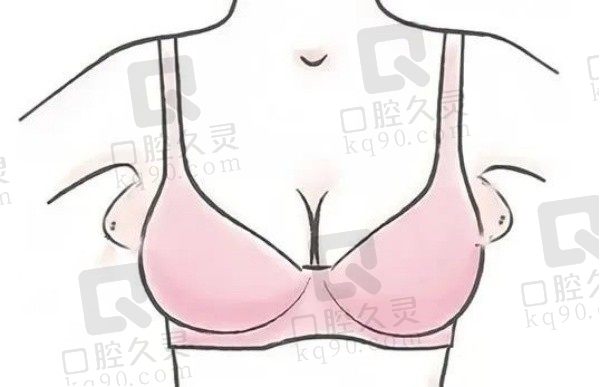 副乳吸脂后有硬块是什么情况？副乳吸脂切口在哪？会影响到胸吗？