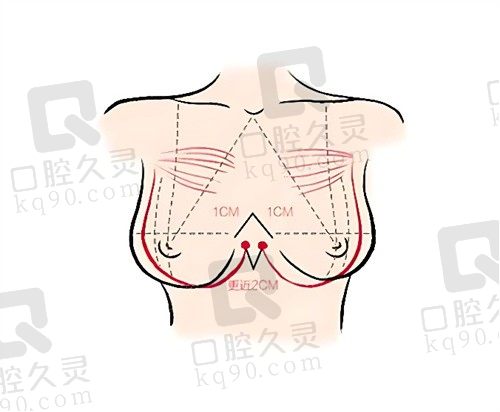 重庆华美曹勇医生曼托尊贵版丰胸39800元，超减张缝合技术疤痕轻成效自然