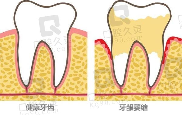 牙齿松动了可以固定吗？固定松动牙齿多少钱一颗？