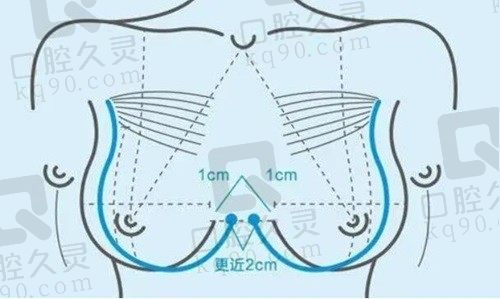 北京米兰柏羽丽都隆胸技术好，可提前预约2-18万的大容量假体丰胸术