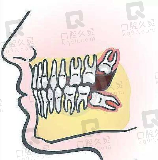 如何判断自己长智齿了？智齿有必要拔吗？