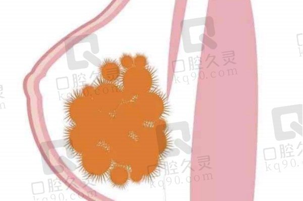 注射英捷尔法勒隆胸20年不可以不取，广州荔湾全息六维层离清奥术一次性能取干净