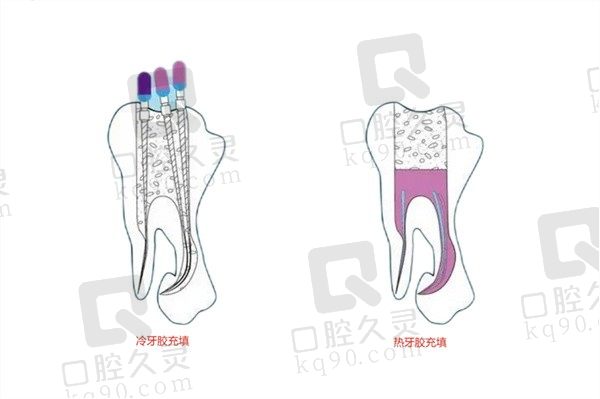 热牙胶充填的优点和缺点都有啥？它和传统冷牙胶哪个好？