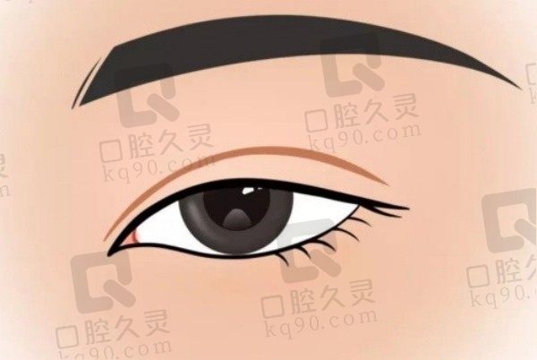 武汉谭琳双眼皮修复案例反馈:术后3个月恢复不错,双眼皮很自然