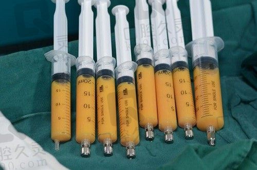 北京純脂脂肪移植怎么樣?從馮斌研創(chuàng)的體內(nèi)提純專項技術(shù)看確實好