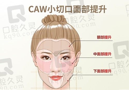 北京黄寺杜太超院长简介：CAW小切口拉皮提升术可重塑面部年轻化