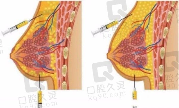 脂肪丰胸一次能大几个罩杯？增大1-2个罩杯,做两次成功维持多年