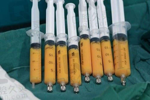 冯斌专注脂肪移植32年,擅长脂肪丰胸/丰臀,可在线预约冯斌脂肪移植
