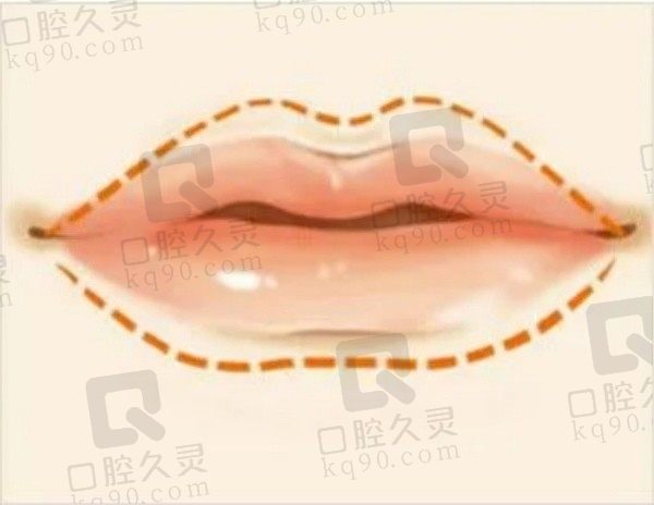 丰唇玻尿酸用什么牌子？乔雅登质颜/瑞蓝2号/国产姣兰等是丰唇专用
