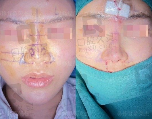上海范荣杰医生口碑怎么样?没听说范荣杰做鼻子有返修率的案例!