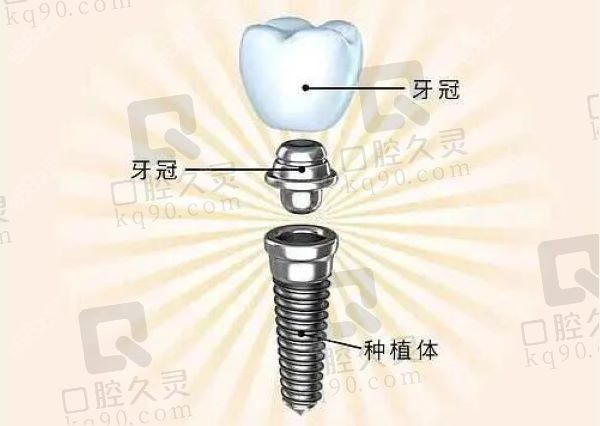 焦作军美口腔韩国奥齿泰种植牙4000元起，稳固耐用媲美真牙