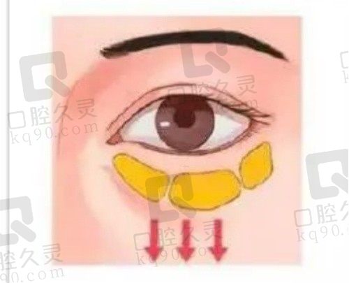 上海美诗沁宣瑞军去眼袋怎么样?他的不开刀祛眼袋效果好口碑爆棚