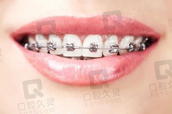 青岛马泷齿科郭颖做金属托槽矫正15988元起，经验丰富好评连连！