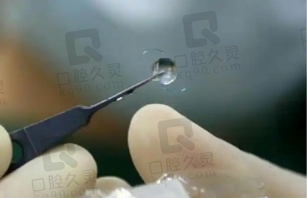 人工角膜可靠吗一般能保几年？人工角膜好处多使用的寿命也长