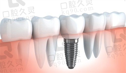 登腾和奥齿泰哪个好？登腾和奥齿泰的愈合基台通用吗？