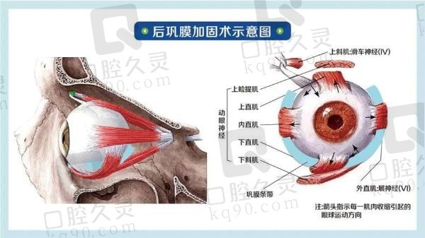 后巩膜加固术4万贵吗能报销吗？不算贵要看材料和医生且可走医保