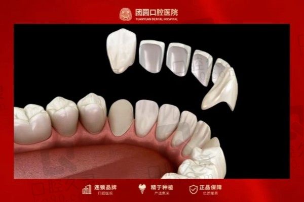 昆明团圆口腔医院瓷贴面美白1800元起，遮盖牙黄修复损伤