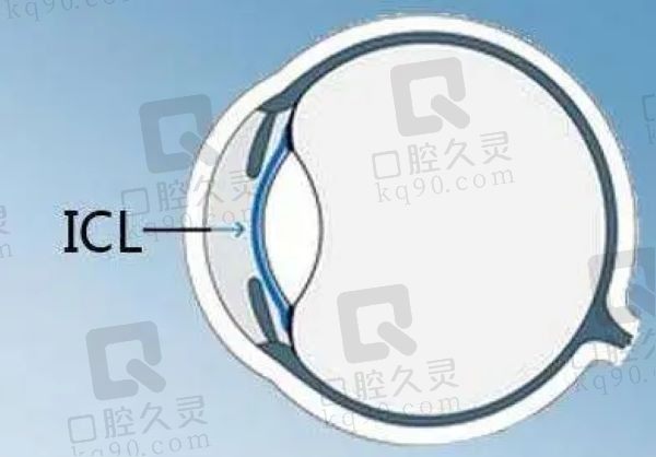 兰州爱尔ICL晶体植入28000元起，姚慧医生是ICL手术认证医生技术很可靠
