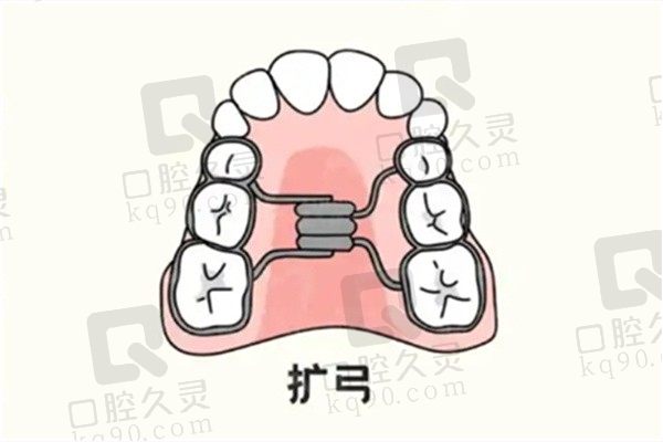 汇总10条儿童扩弓矫正牙齿的利弊！看看扩弓器矫正牙齿原理