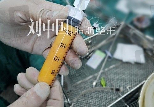 北京刘中国脂肪填充好吗?专注脂肪移植25年 上万例成功案例0事故