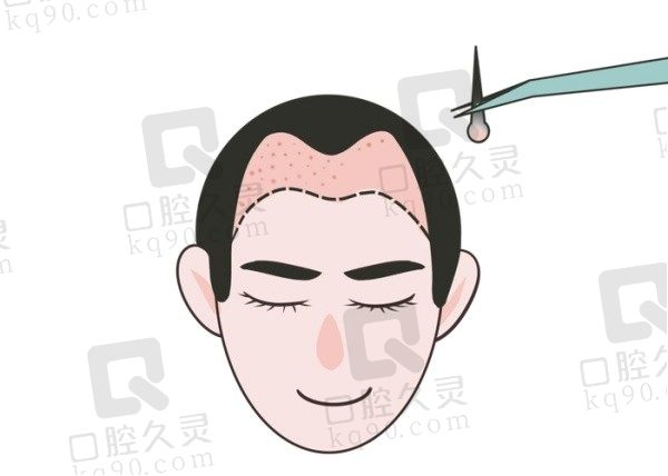 南宁植发有哪些正规医院？公布口碑人气榜单前5的正规医院及价格