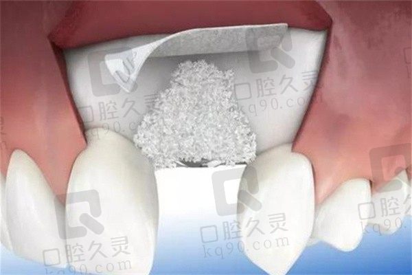 GBR手术能修复牙龈吗？详解口腔gbr手术操作步骤和作用