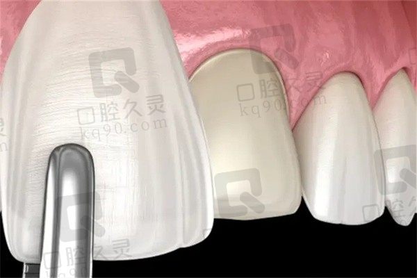 上海牙齿贴面需要多少钱一颗？上海牙贴面价格800起附医院推荐