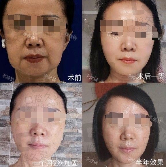 成都李建钢医生电话预约联系方式,在线/微信都可直接预约李建钢无痕筋膜提升!