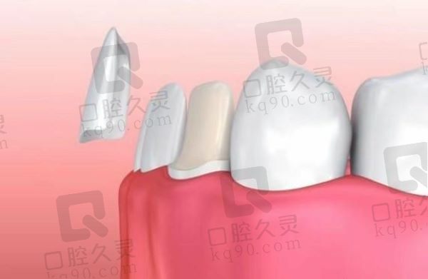 温州艺星口腔E-MAX瓷贴面959元起，价格实惠美观度高