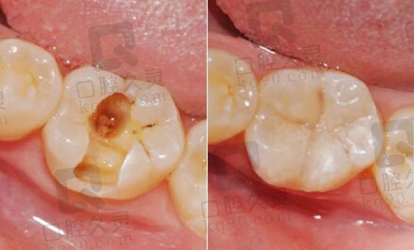 哈尔滨优诺口腔美国Z350树脂补牙299元起，美观坚硬不易脱落