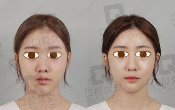 杭州高俊明磨骨怎么样多少钱?高俊明磨骨风格/费用/手术实例分享