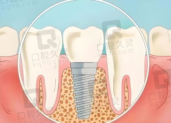 齐齐哈尔魁杰口腔利多齿种植牙1680元起，价格便宜美观耐用