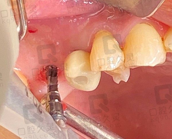 内江种植牙哪家便宜价格不贵？三大性价比医院曝光，最低2280元起种一颗