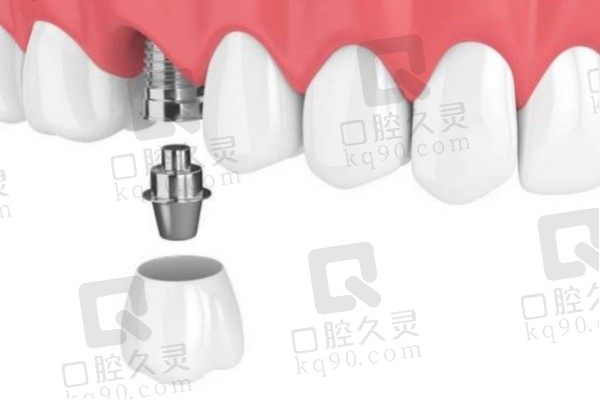 镇江维乐口腔CLC种植牙4980元起，动态导航种牙更精细