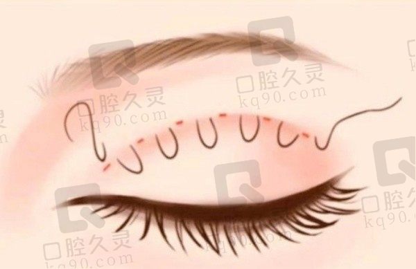 上海王衡健医生做双眼皮价格1w元起,擅长妈生款双眼皮技术可靠
